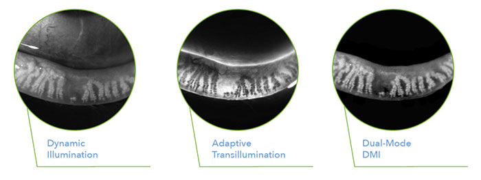 LipiScan meibomian gland imaging at Will Vision & Laser Centers